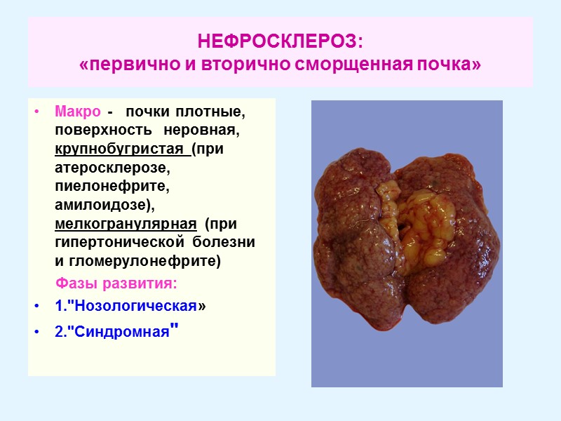 НЕФРОСКЛЕРОЗ: «первично и вторично сморщенная почка» Макро -   почки плотные, поверхность 